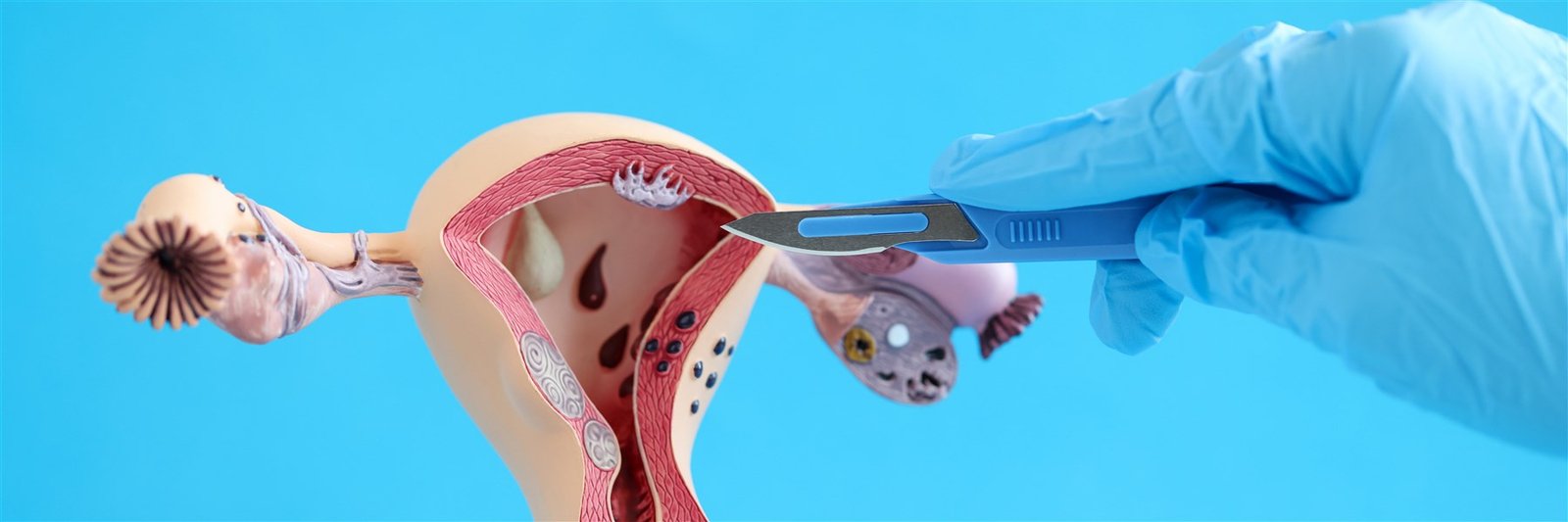 Laparoscopic Myomectomy